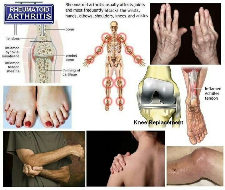 Pin by ðShaymað on Rheumatoid arthritis& diseases