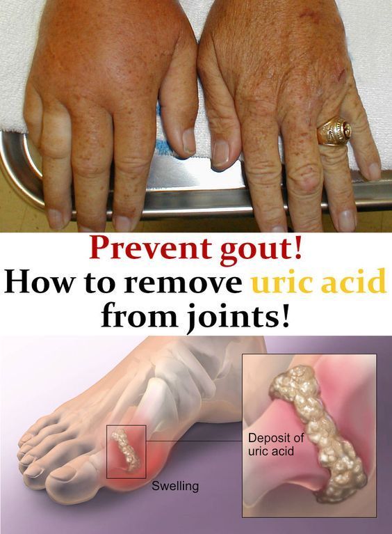 Pin on Cure Gout