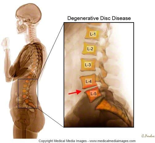 Pin on Lumbar Degenerative Disc Disease shown on Color X