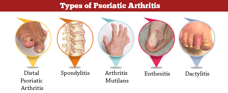 Pin on Psoriasis, Psoriasic Arthritis &  Co.
