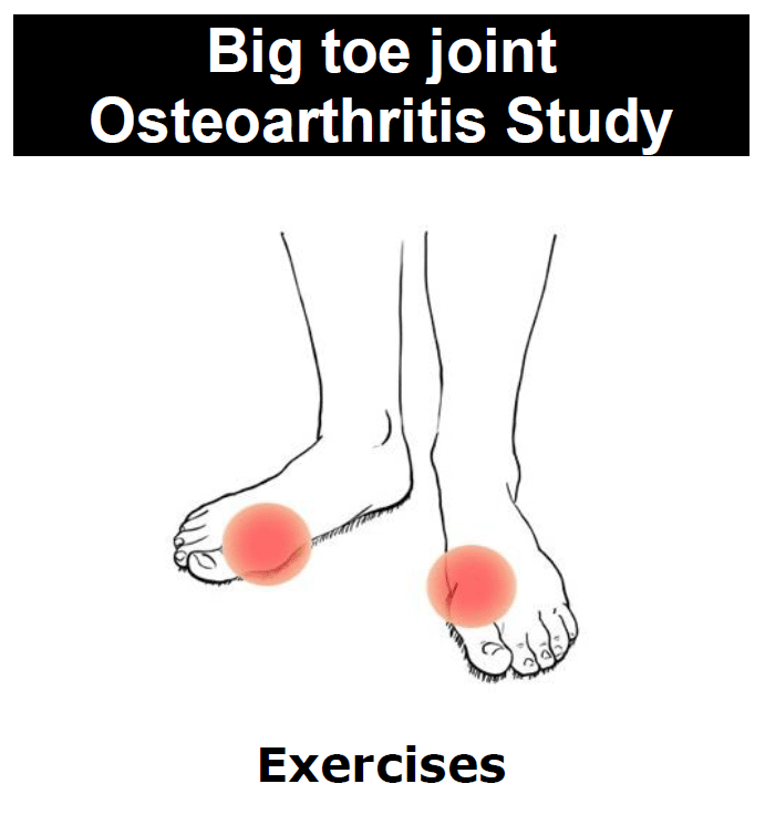 Podiatry management of big toe joint osteoarthritis