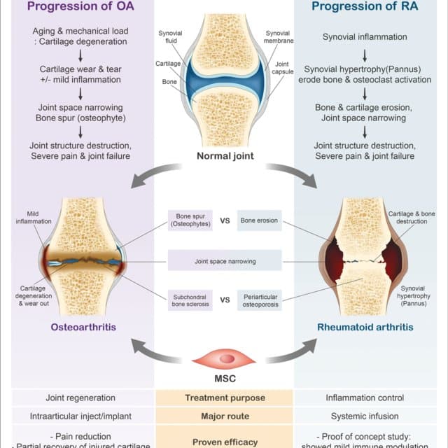 progression of rheumatoid arthritis ra and osteoarthritis oa in