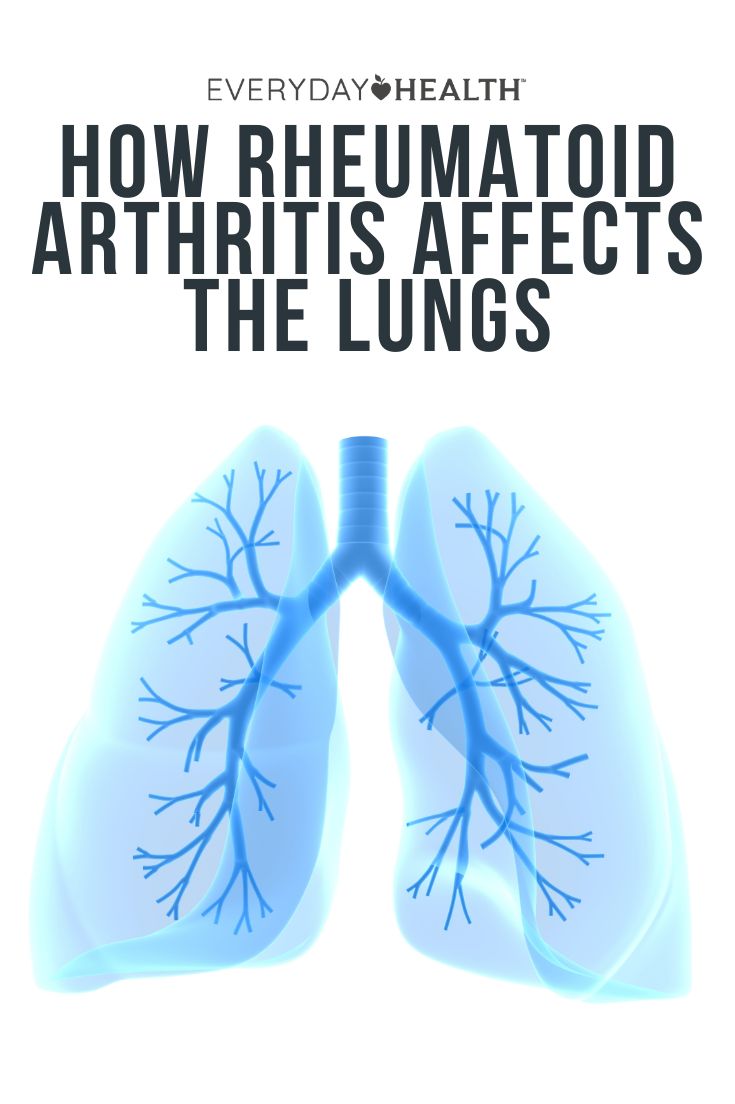 Protect Your Lung Health When You Have Rheumatoid ...