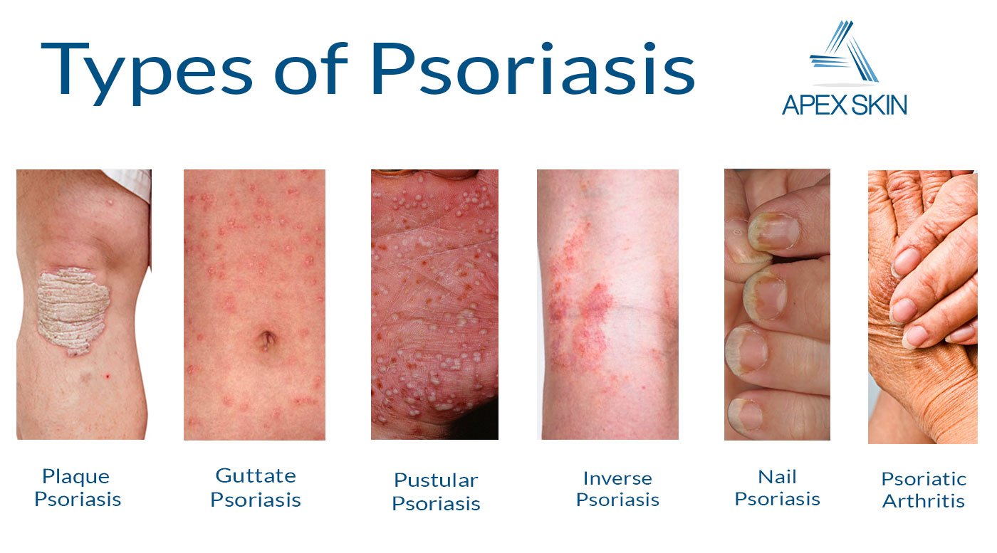 Psoriasis: Everything You Need to Know About This Chronic Skin ...