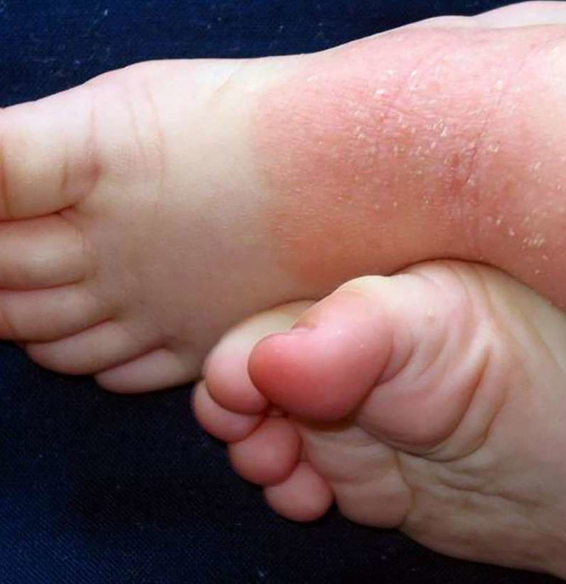 Psoriasis on feet: Symptoms, causes, and treatment