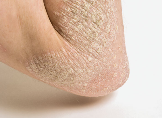 can-psoriasis-lead-to-arthritis-arthritisdaily