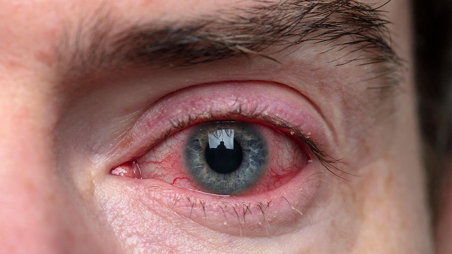 Psoriatic Arthritis and Eye Problems