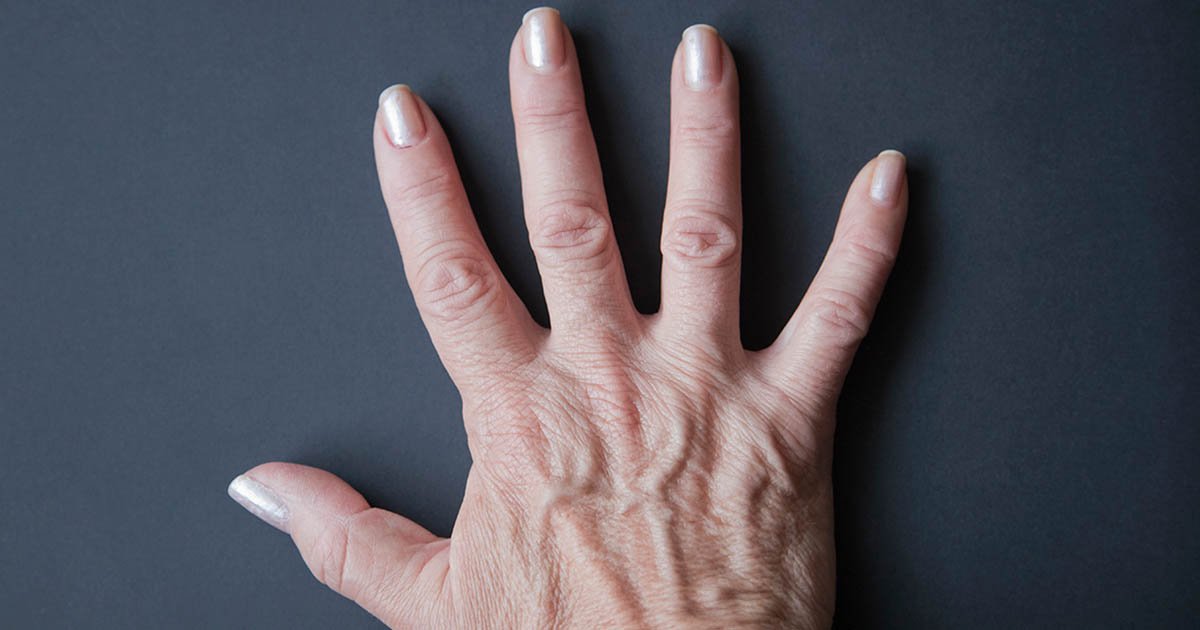 Psoriatic Arthritis: Caring for Your Hands and Feet