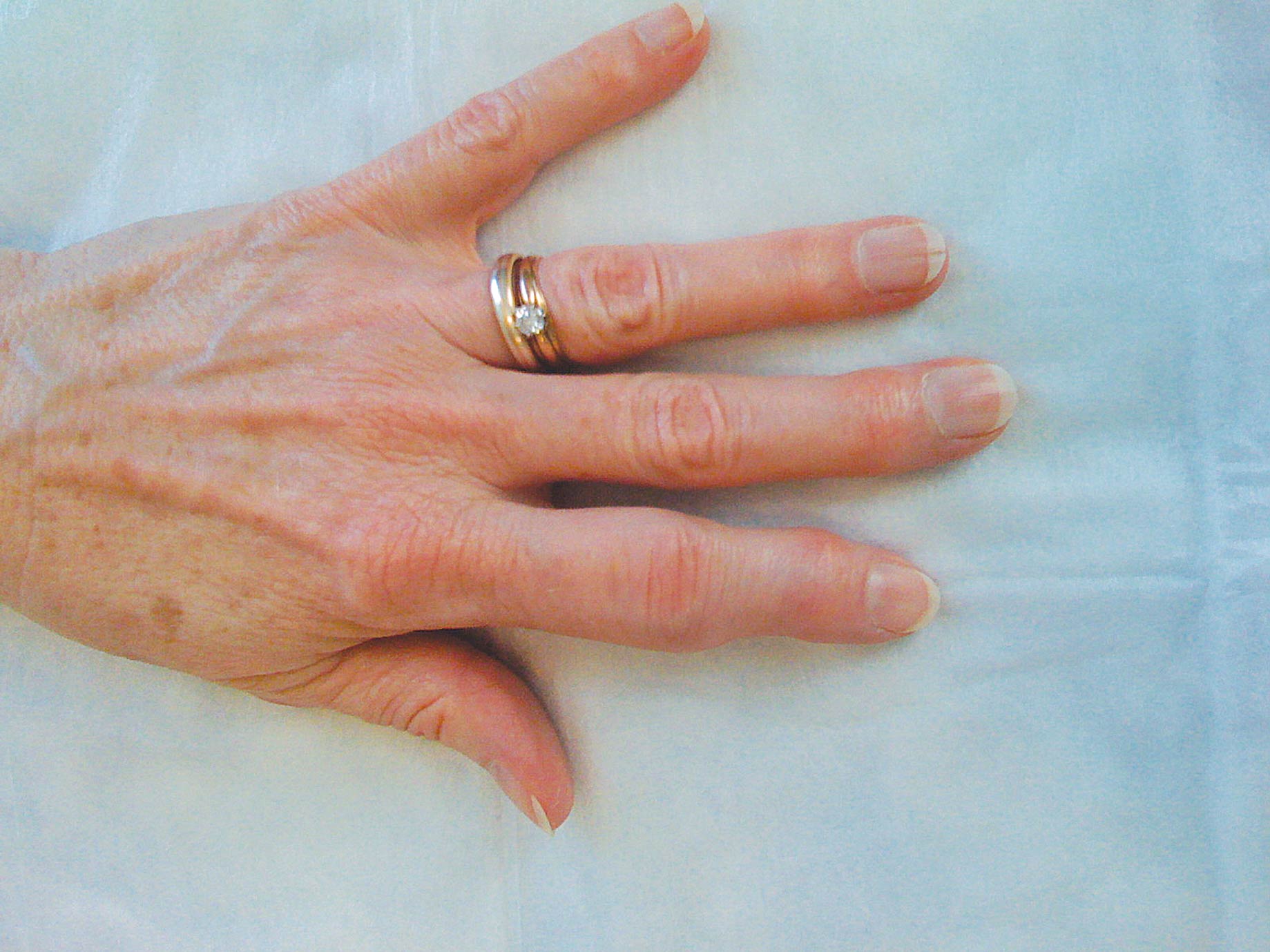 Psoriatic arthritis. Causes, symptoms, treatment Psoriatic ...