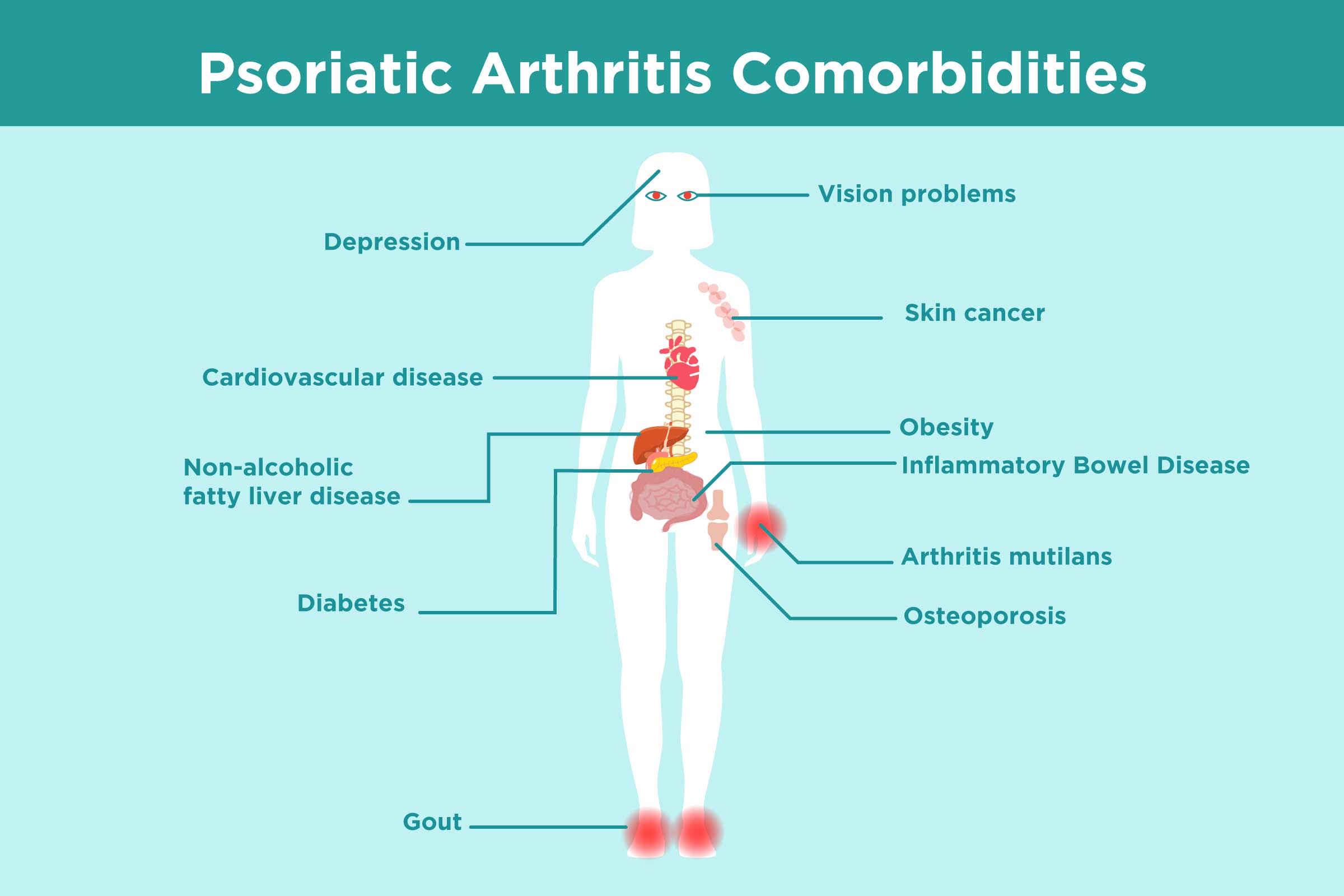 Psoriatic Arthritis Comorbidities: What Patients Need to Know