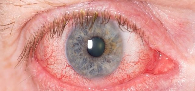 Psoriatic Arthritis Eye Symptoms