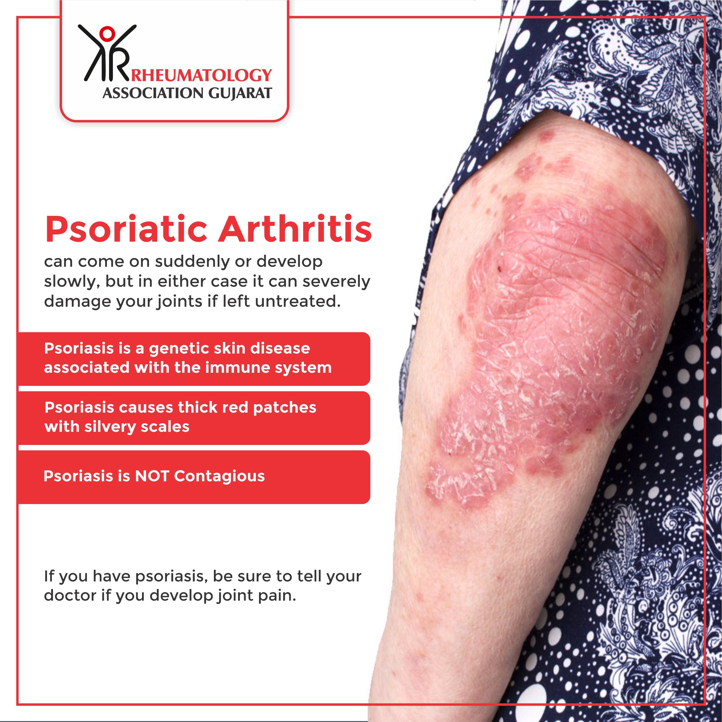 Psoriatic arthritis in 2020