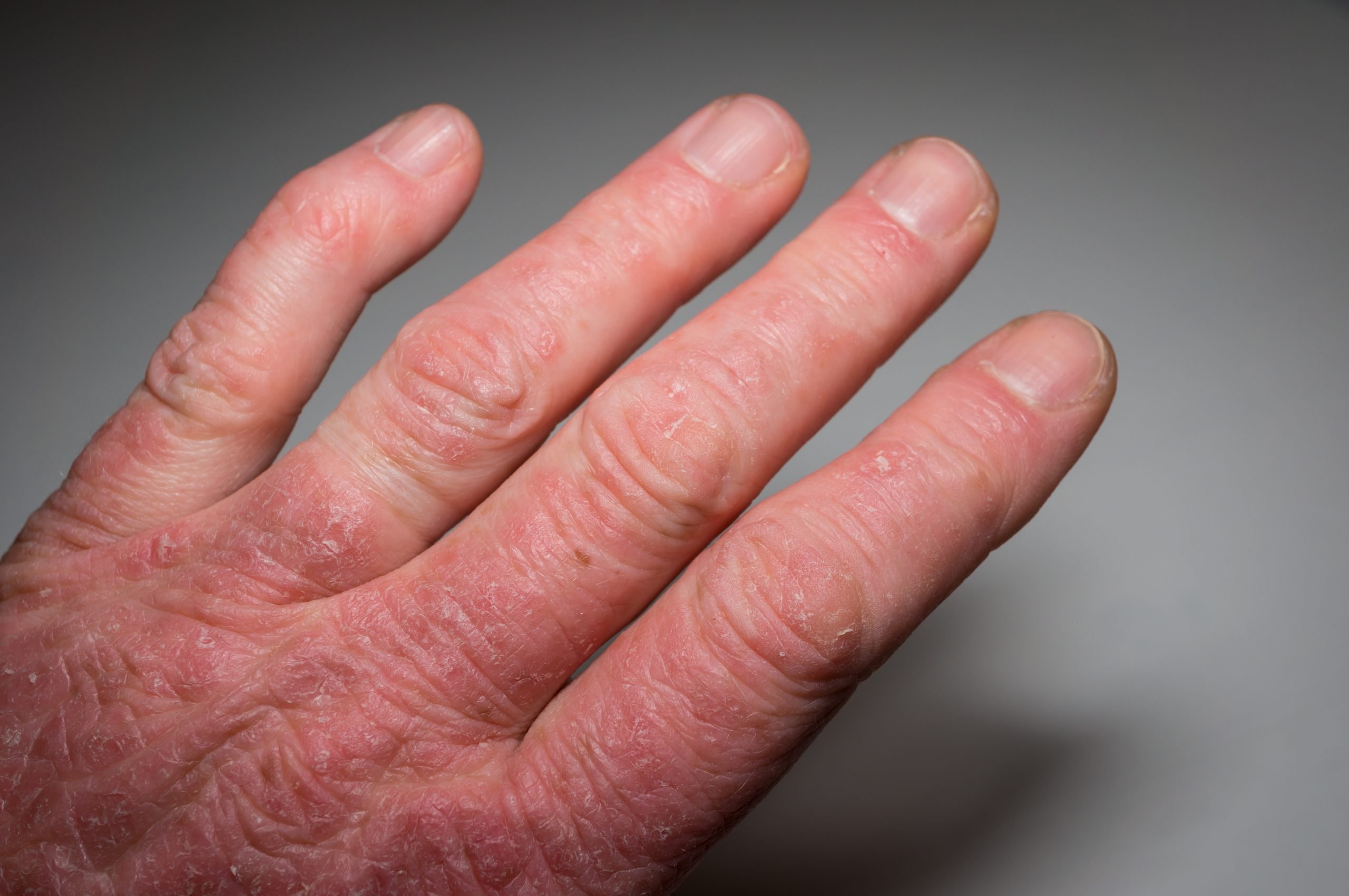 Psoriatic Arthritis in Adults