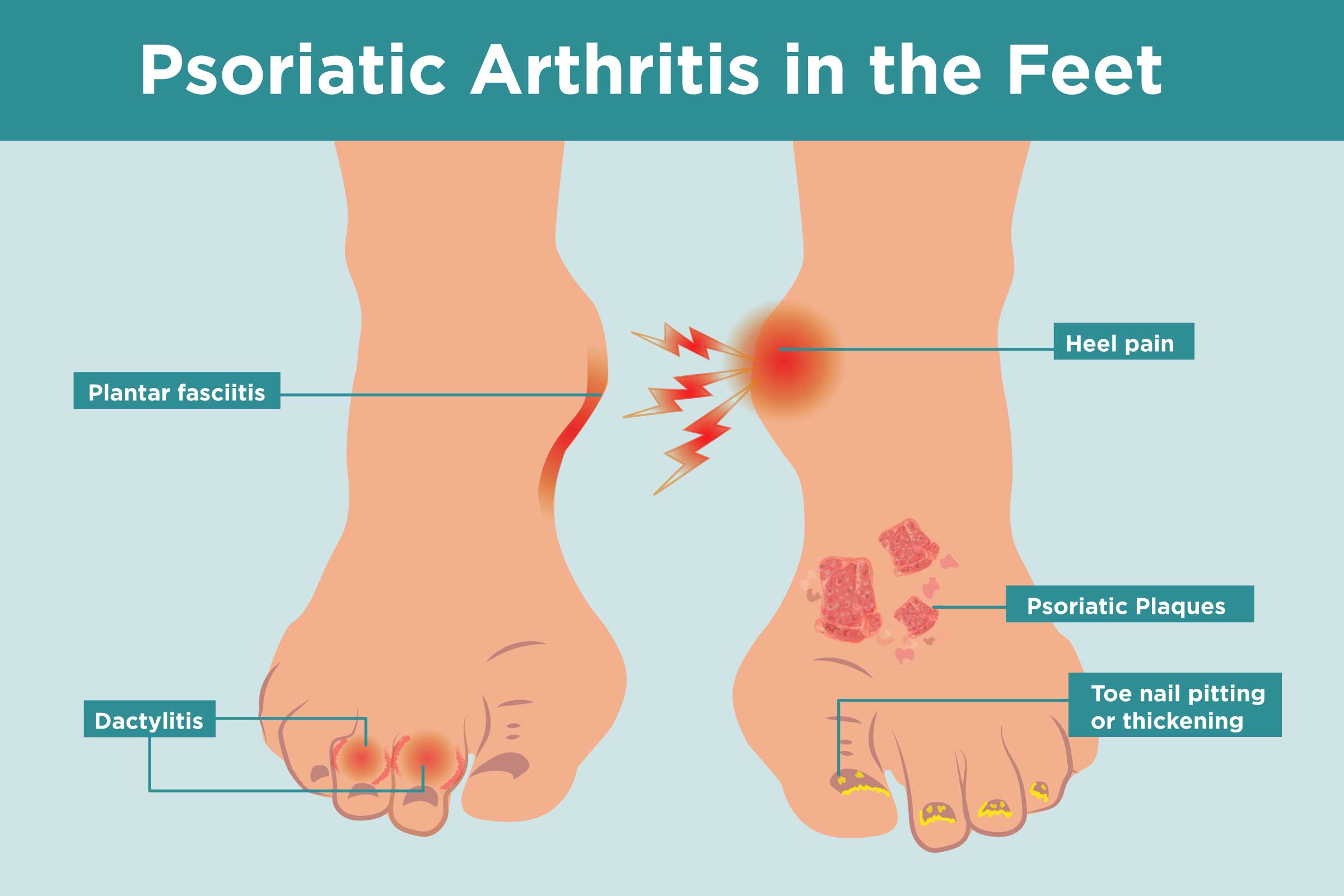 Psoriatic Arthritis in the Feet: Symptoms, Treatment, Home Remedies