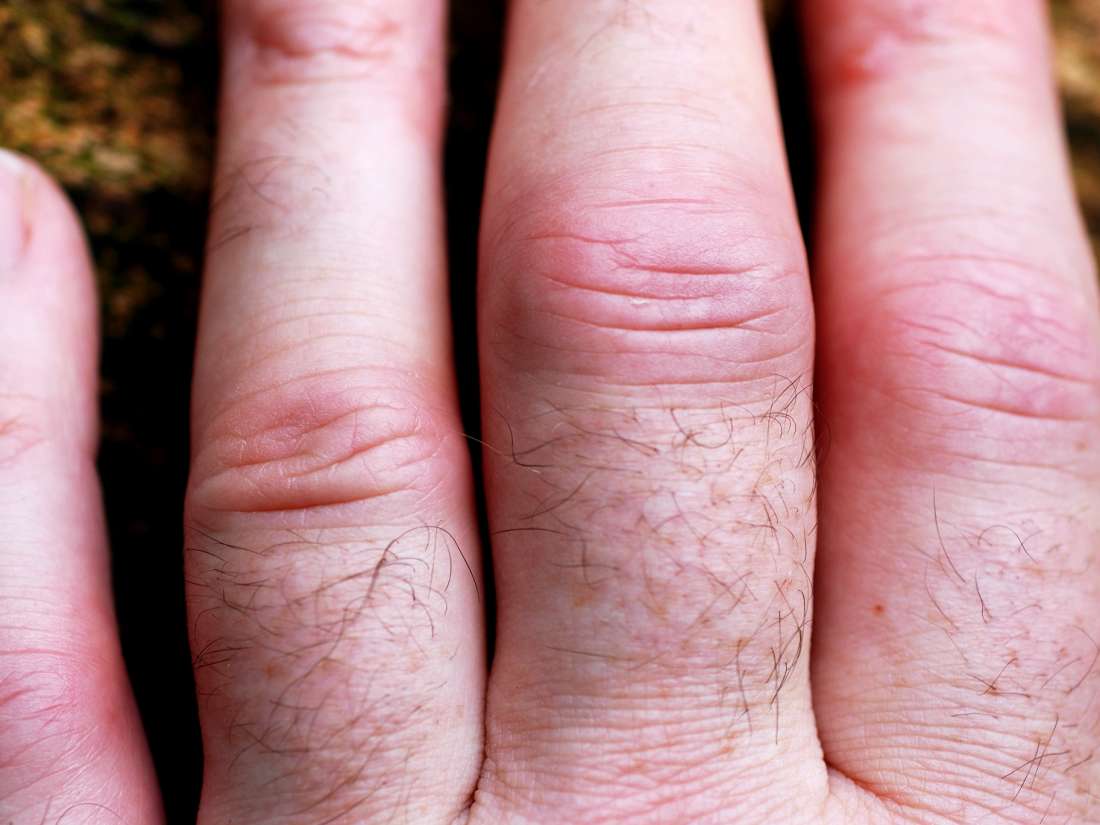 Psoriatic arthritis in the hands: Symptoms, pictures, and treatment