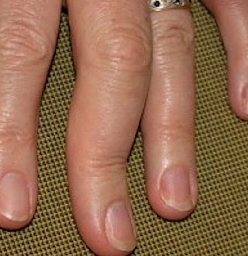 Psoriatic arthritis in the hands: Symptoms, pictures, and ...
