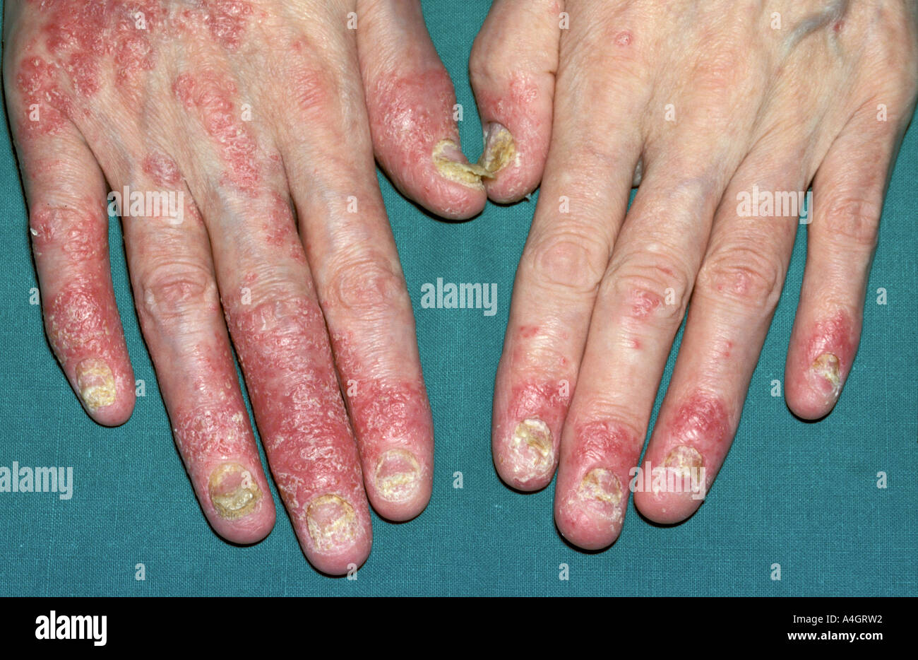 Psoriatic arthritis is a condition that causes swelling and pain in ...
