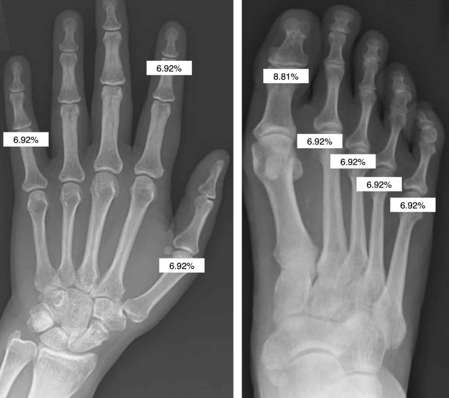 Psoriatic Arthritis Mutilans: Characteristics and Natural Radiographic ...