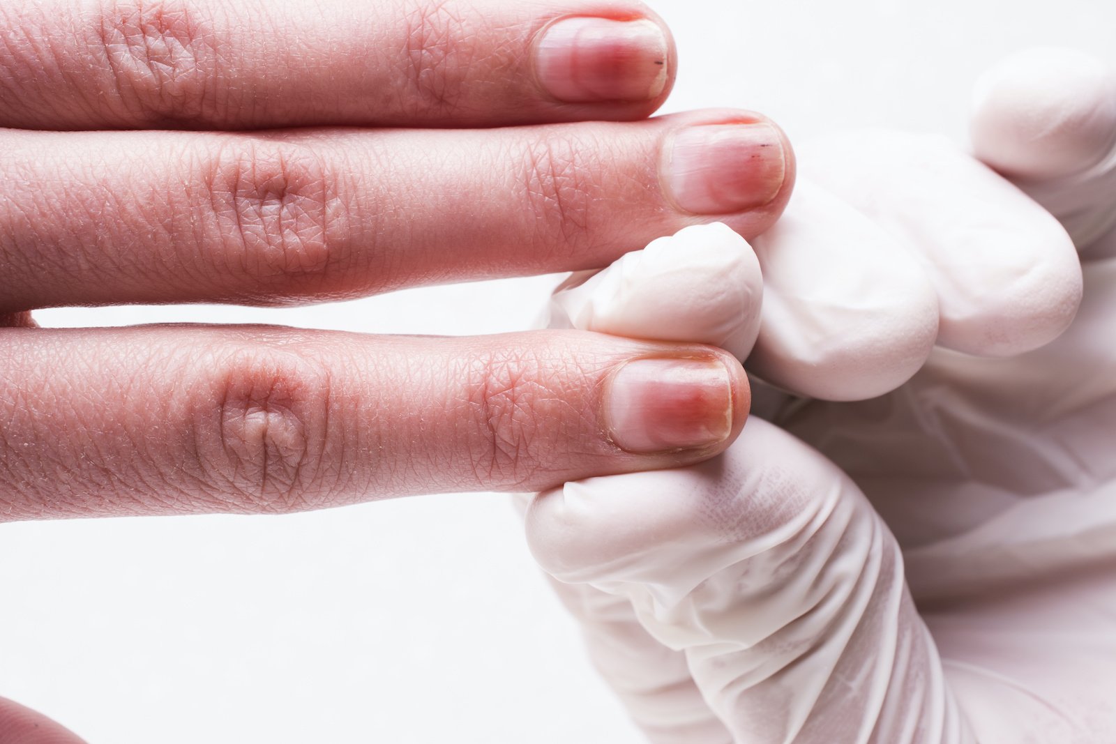 Psoriatic Arthritis  Nail Involvement and Treatment