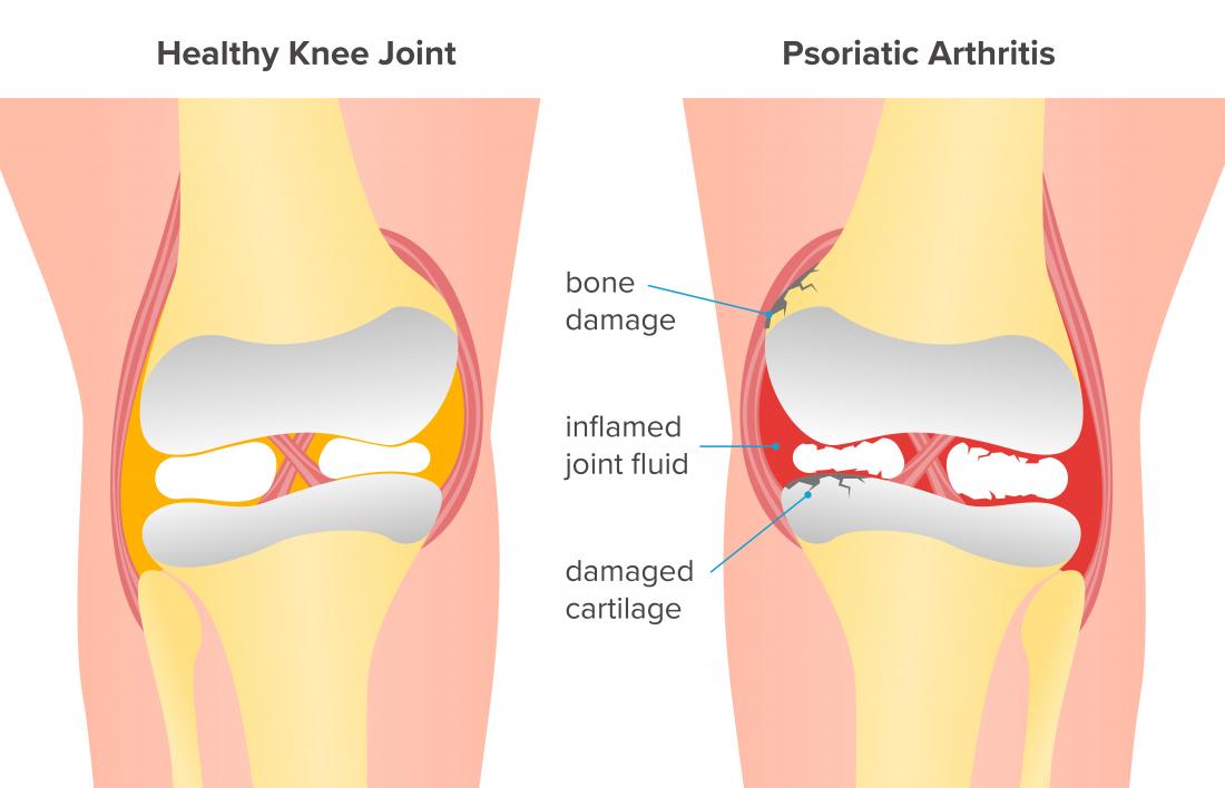 Psoriatic arthritis of the knee: Symptoms and treatment