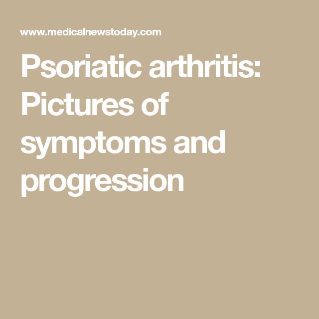 Psoriatic arthritis: Pictures of symptoms and progression
