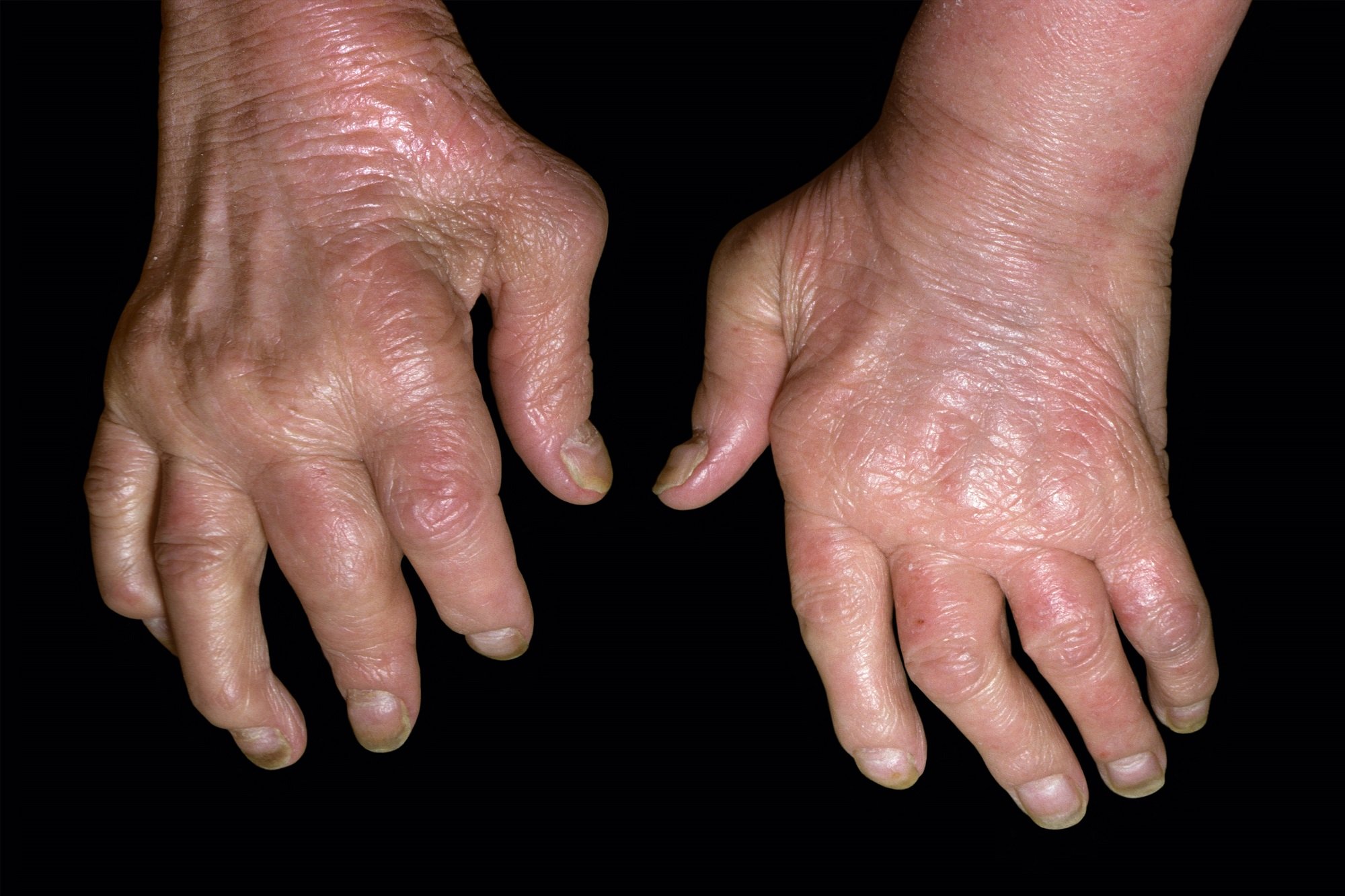 Psoriatic Arthritis Remission Compared With Very Low ...