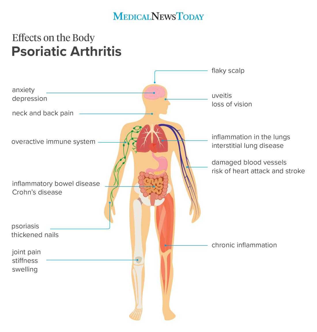 Psoriatic Arthritis Severe Neck Pain Cane Rheumatoid ~ Dcss Arthritis ...