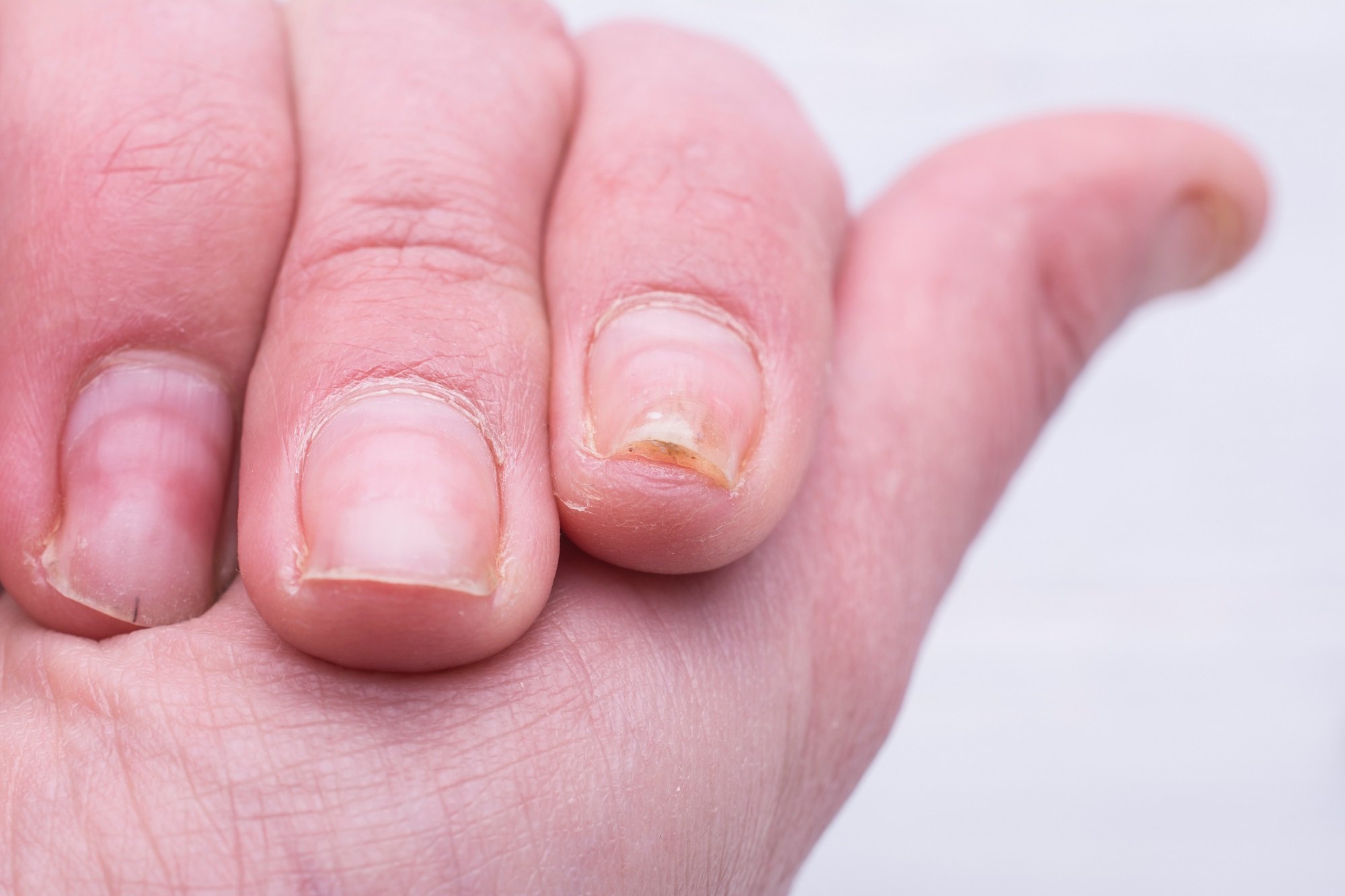 Psoriatic Nail Dystrophy Associated With Erosive Damage at ...
