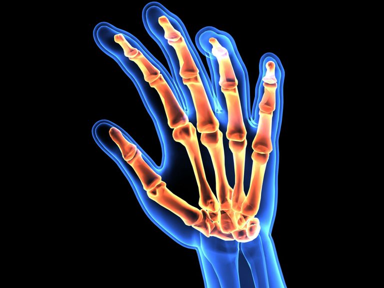 RA  What Is Rheumatoid Arthritis And How It Will Affect ...