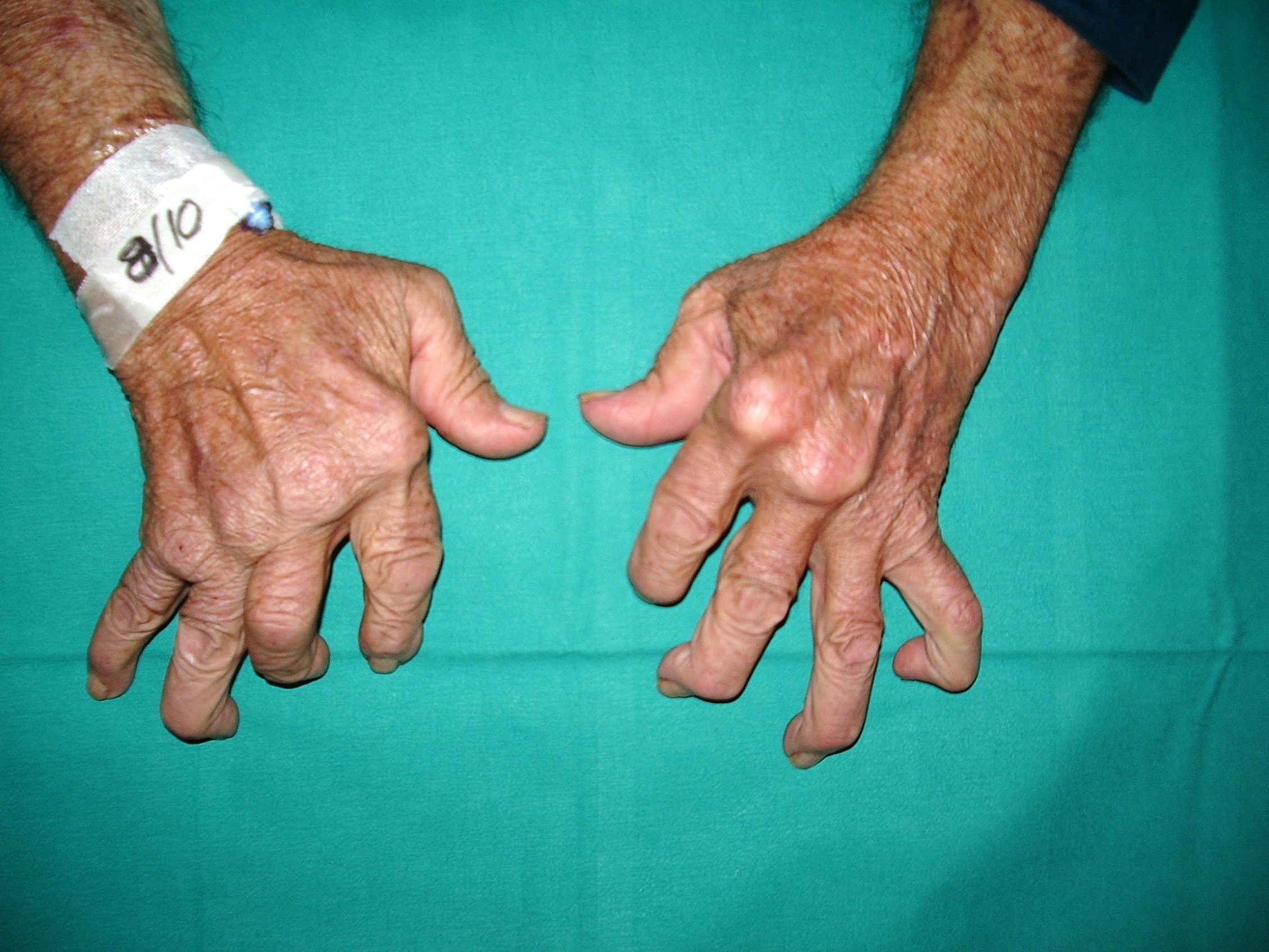 Revolutionary Arthritis Treatment: An End To Chronic Pain