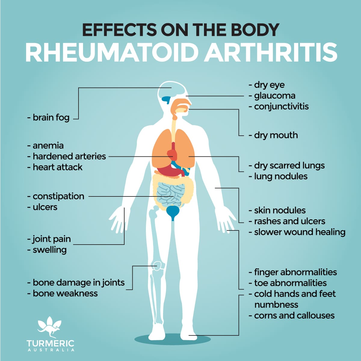 Rheumatoid Arthritis and Cancer: Whatâs the Connection?