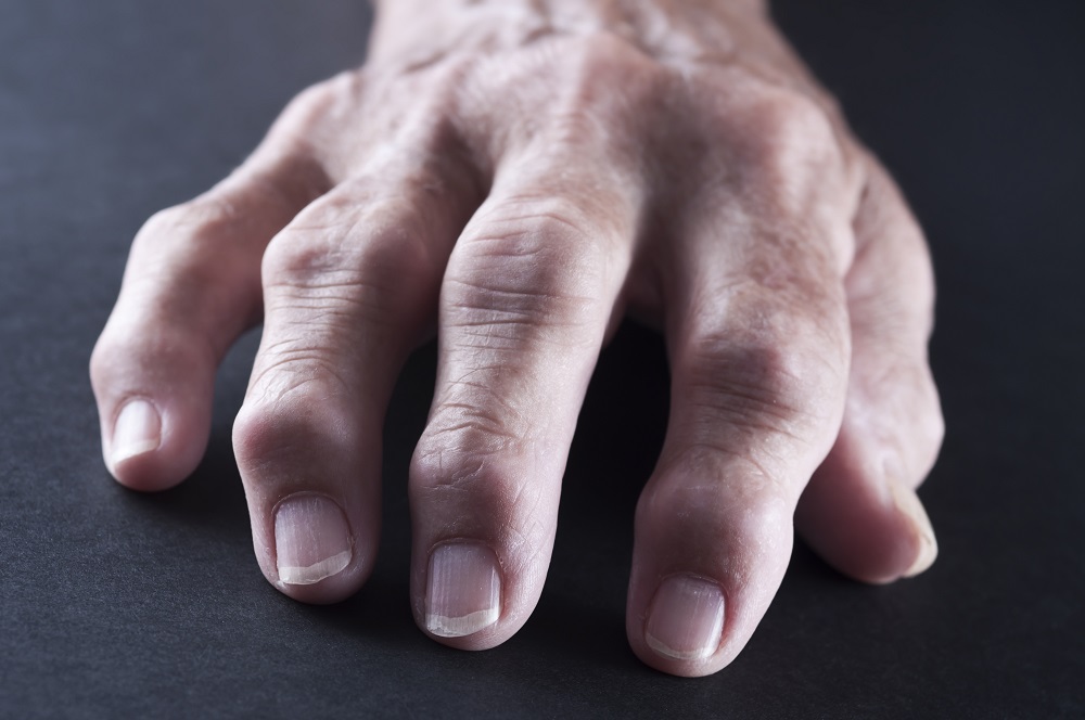 Rheumatoid Arthritis Associated With Lower In