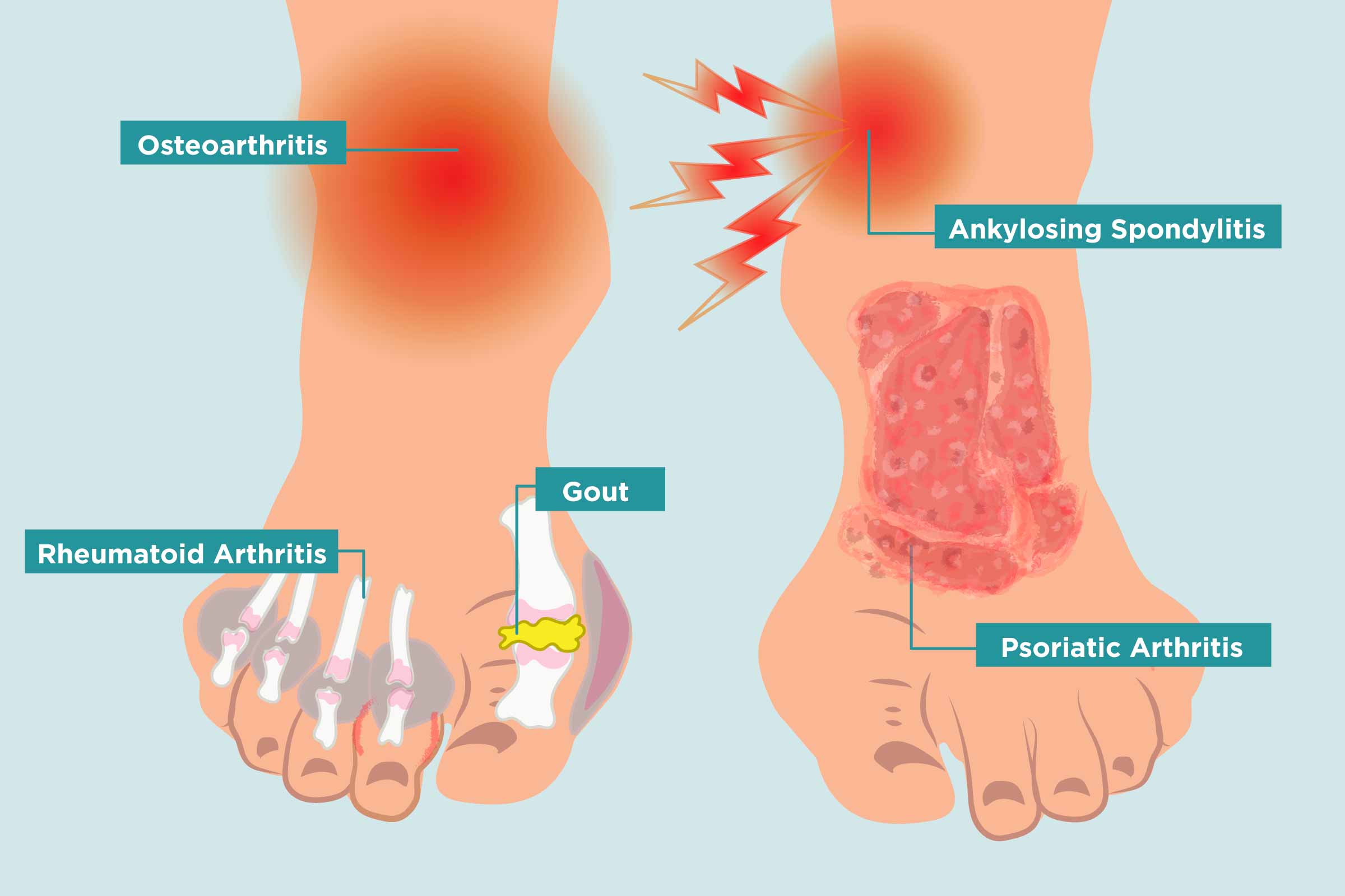 Rheumatoid Arthritis Caused By Gout Paraffin Wax Pain ...