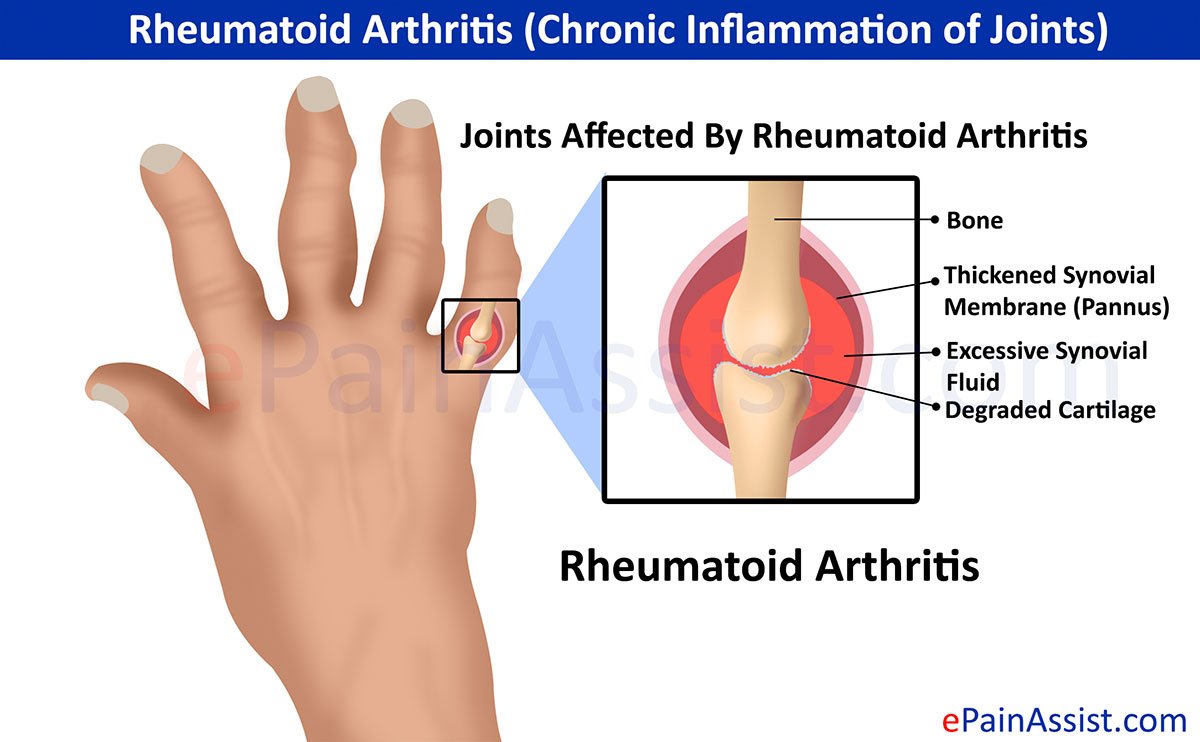 Rheumatoid Arthritis (Chronic Inflammation of Joints)