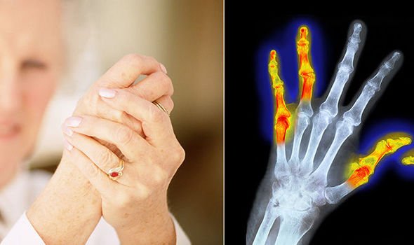 Rheumatoid arthritis diet: Avoid these foods to prevent ...