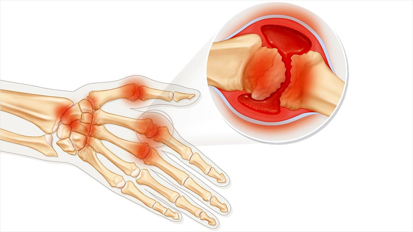 Rheumatoid Arthritis Disease Progression and Symptoms: An ...