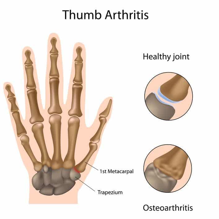 Rheumatoid Arthritis Exercises