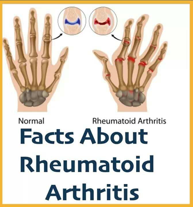 Rheumatoid Arthritis facts