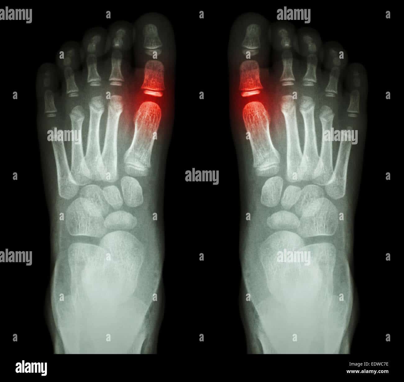 " Rheumatoid arthritis , Gouty arthritis"  X