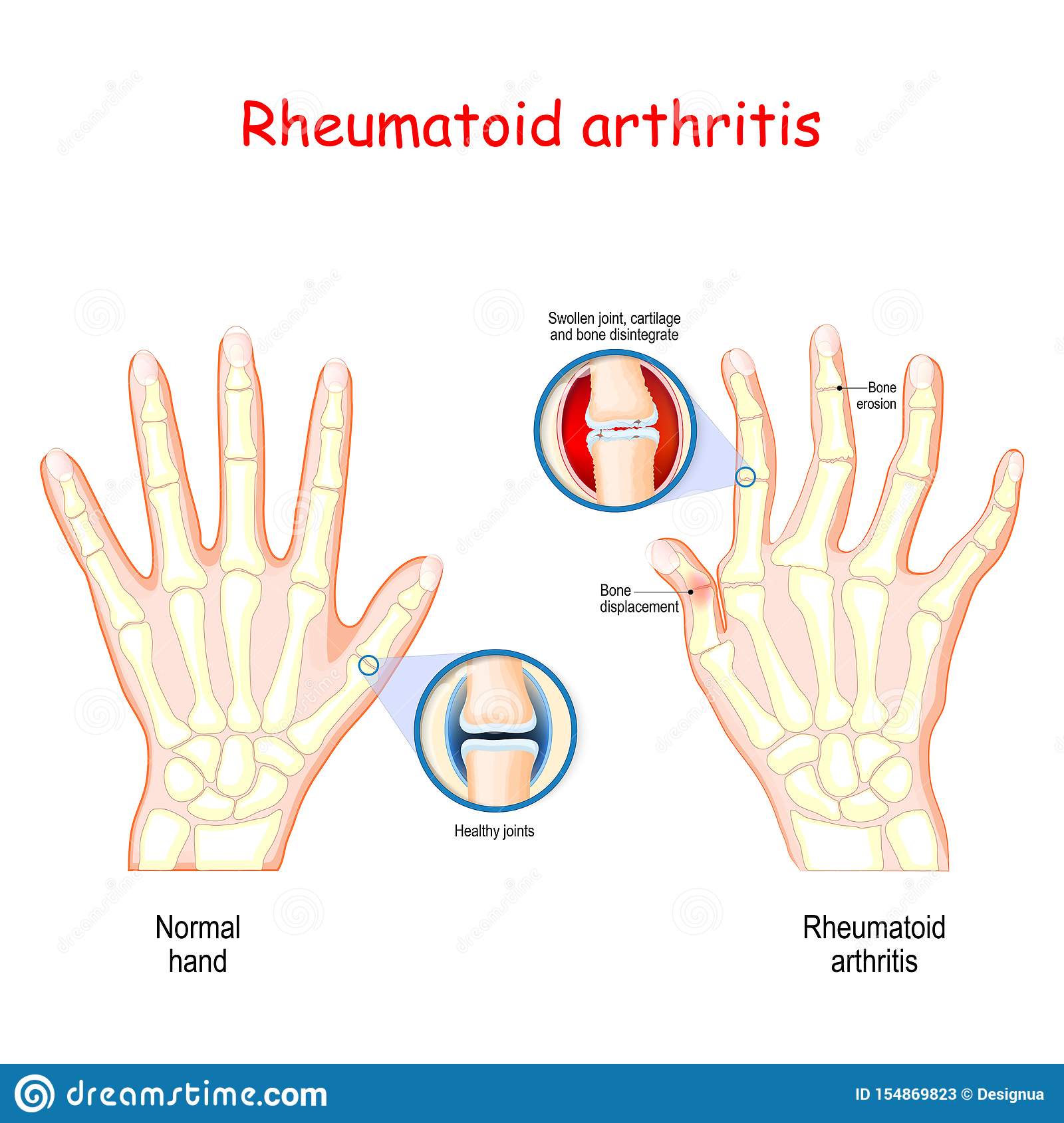 Rheumatoid Arthritis. Healthy Hand, and Hand with Rheumatoid Arthritis ...