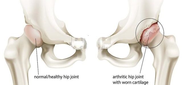 Rheumatoid Arthritis Hip Pain Relief