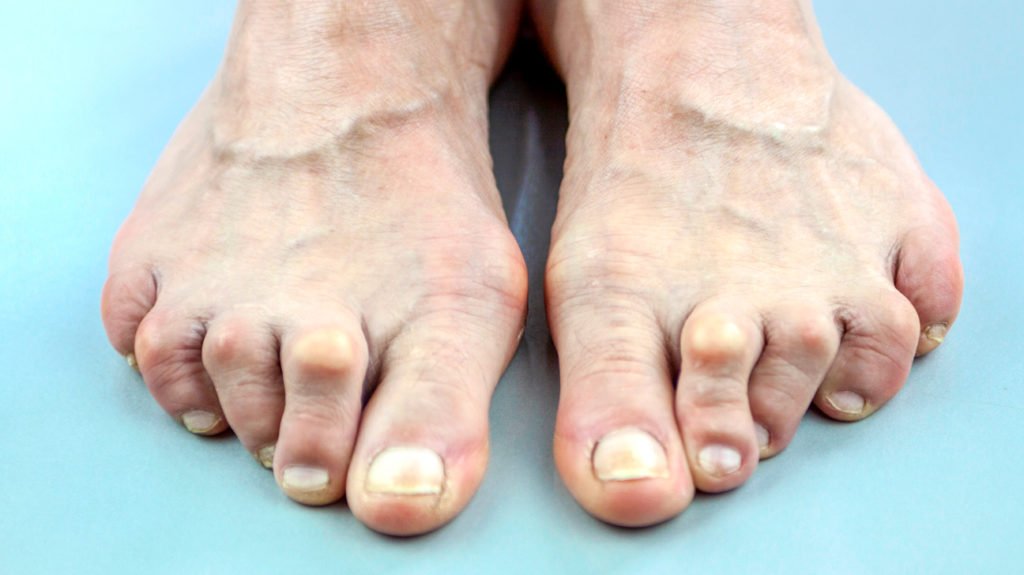 Rheumatoid Arthritis in Feet: Symptoms, Treatments, and More