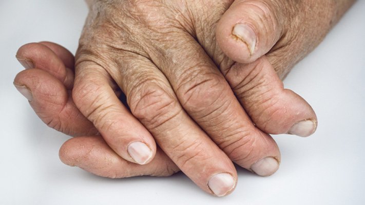 Rheumatoid Arthritis Linked To Serious Mood Disorders ...