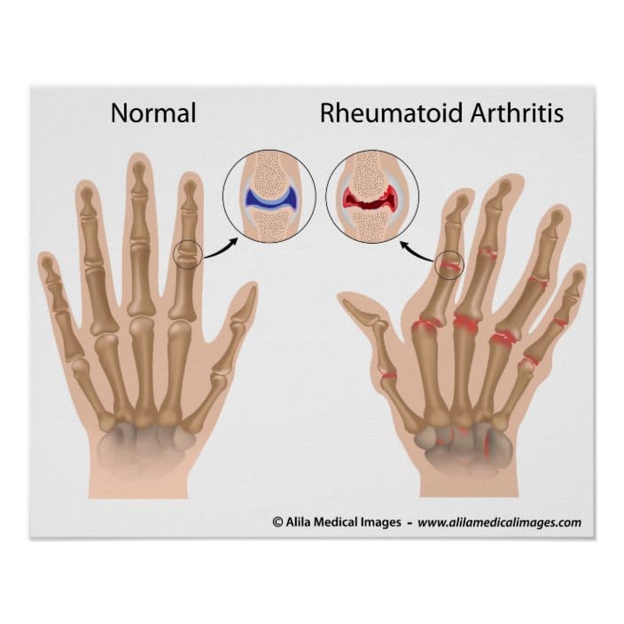 Rheumatoid arthritis of finger joints, diagram. poster