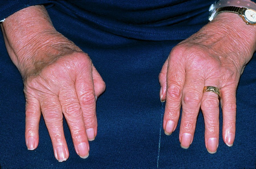 Rheumatoid Arthritis Of Hands With Ulnar Deviation Photograph by ...