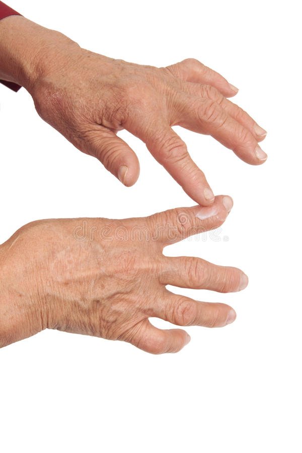 Rheumatoid Arthritis Of The Fingers. Using Medical Cream Stock Photo ...