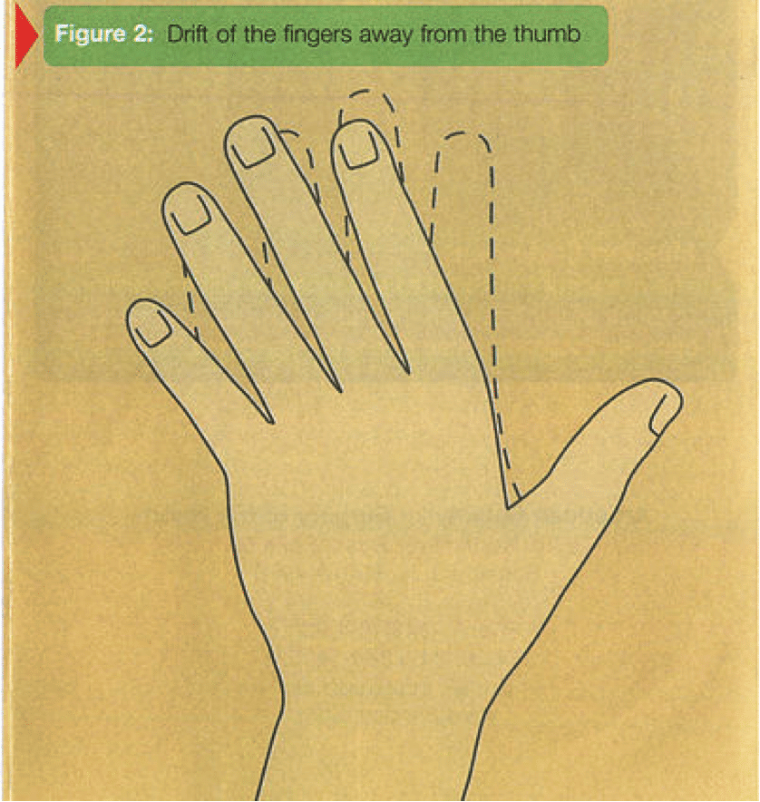 Rheumatoid Arthritis of the Hand Â» Irvine, CA