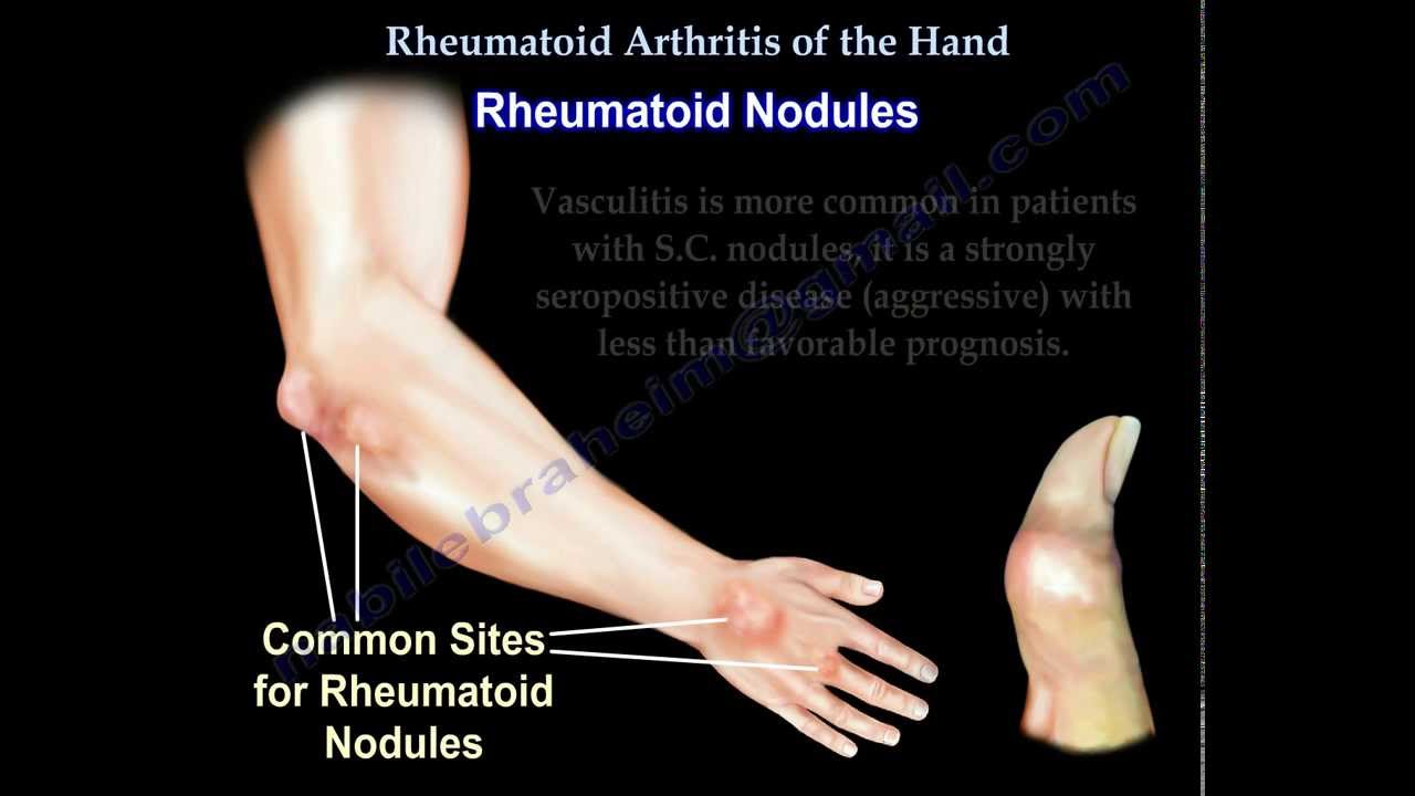Rheumatoid Arthritis of the hand