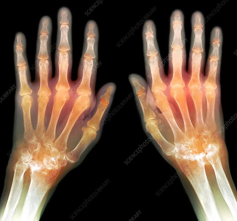 rheumatoid arthritis of the hands x ray stock image c0032991