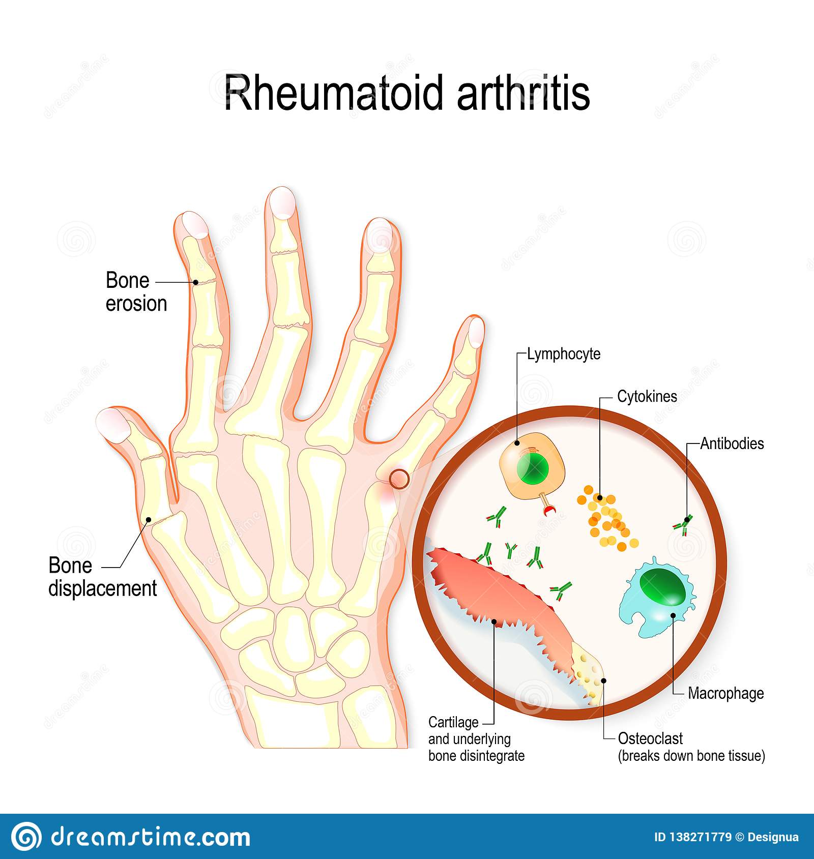 Rheumatoid Arthritis RA Is An Auto Immune Disease And Inflammatory Type ...
